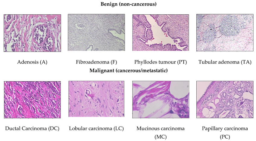 Types of Breast Cancer